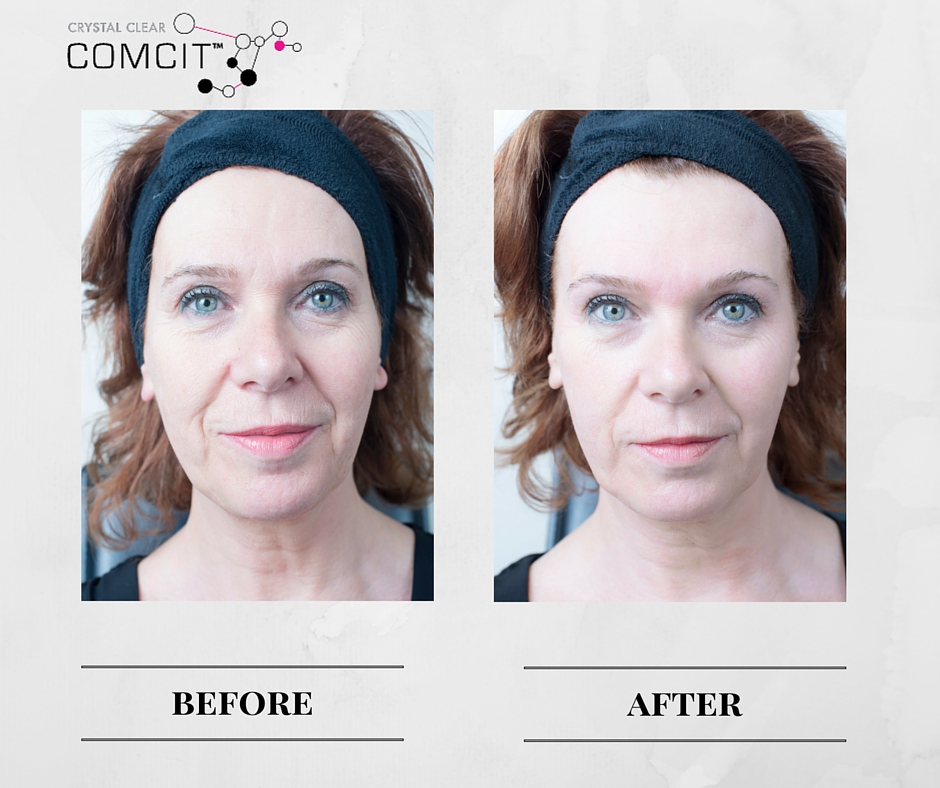Crystal Clear COMCIT Before And After 